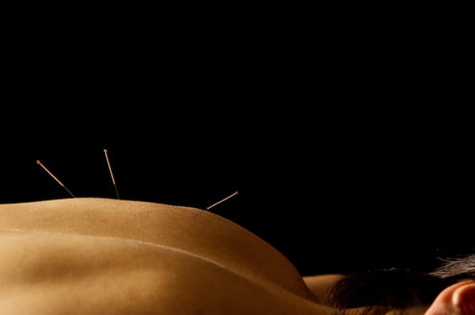 Woman getting an acupuncture treatment in a spa