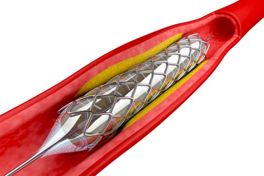Balloon angioplasty procedure with placing a stent