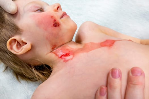 medical procedure dressing a boy with a first-degree burn from boiling water on his face, neck and chest