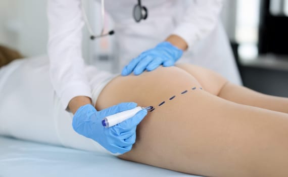 Doctor draws marks on the patient's buttocks with marker for body shaping. Buttocks plastic concept