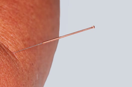 Acupuncture Treatment