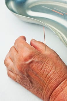 Acupuncture Treatment