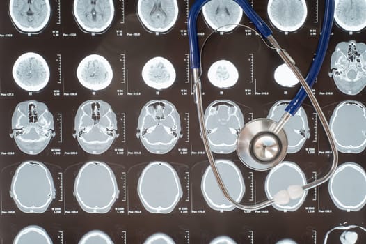 Stethoscope lying over medical head x-ray