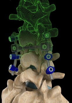 Rendering of a spine with a screw support system and a computer generated wire frame on a black background.