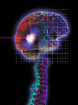 Diagram of Radiosurgery being performed.
