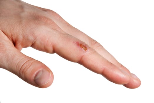 a small wound on a finger, isolated