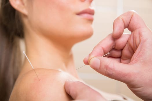 Doctor hands acupuncture needle pricking on woman patient closeup