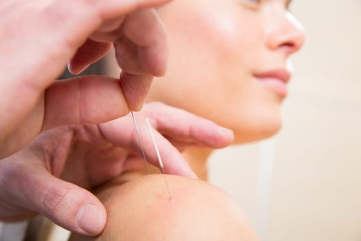 Doctor hands acupuncture needle pricking on woman patient closeup