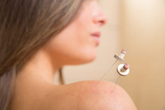 moxibustion acupunture needles heat on woman shoulder closeup