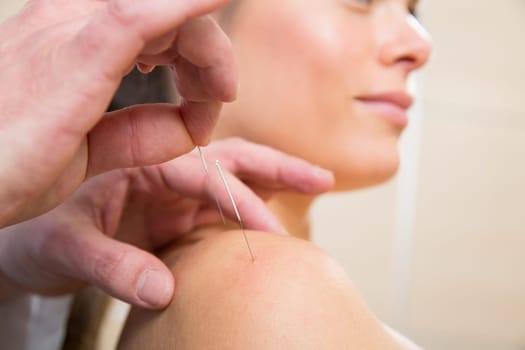 Doctor hands acupuncture needle pricking on woman patient closeup