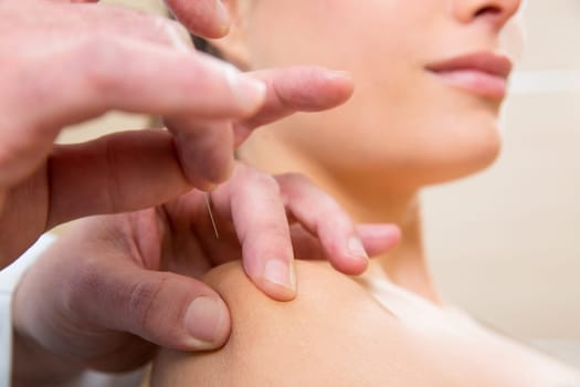 Doctor hands acupuncture needle pricking on woman patient closeup