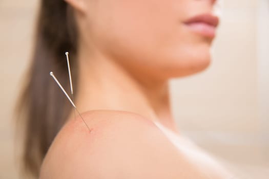 Acupuncture needle pricking on woman shoulder therapy closeup