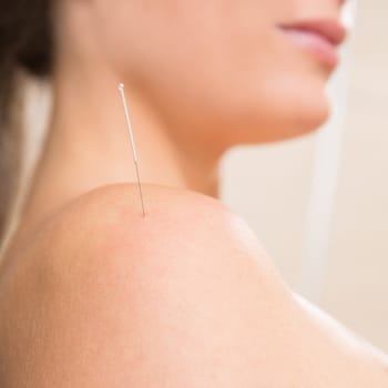 Acupuncture needle pricking on woman shoulder therapy closeup