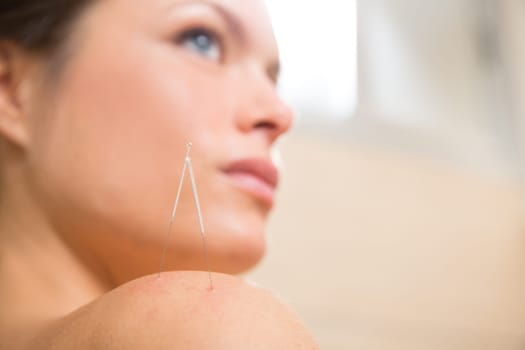 Acupuncture needle pricking on woman shoulder therapy closeup