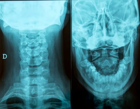 Radiography front and back of the head