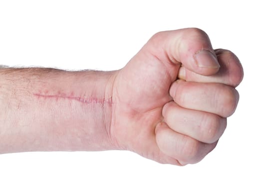 scar