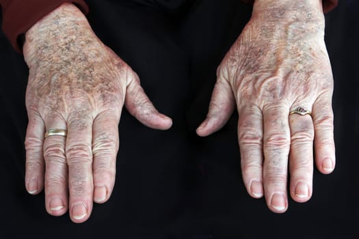 Psoriasis
