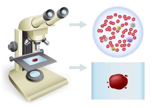 Analysis of blood under a microscope on a white background, two views