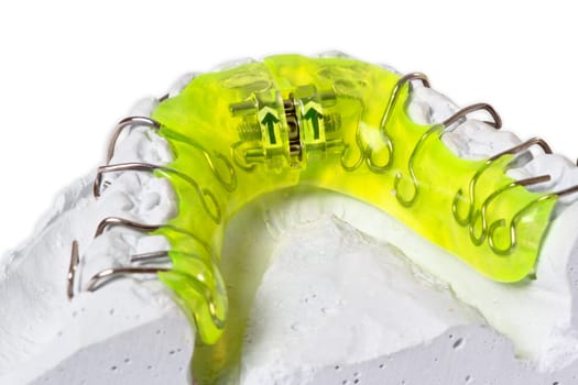 Plaster cast with braces