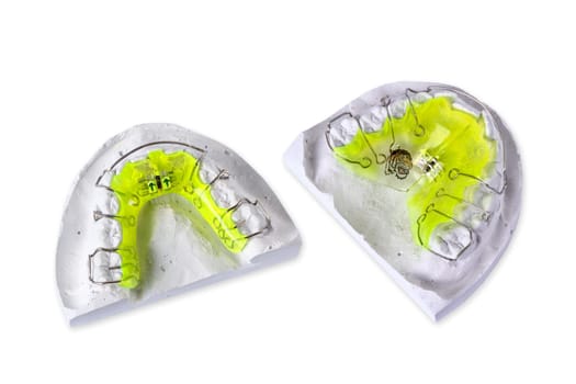 Upper and lower jaw,braces