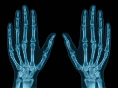 X-ray of both hands. Concept of exam.