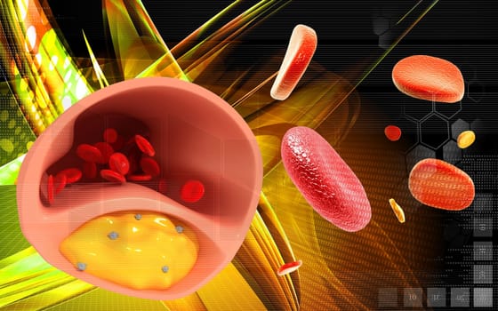 Digital illustration of Cogged arteries in colour background