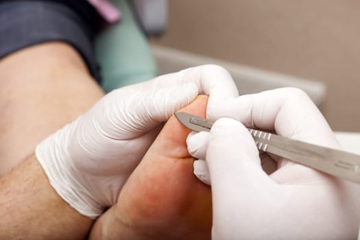 Remove dry skin with scalpel
