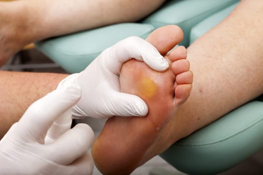 Foot care worker sprays foot sole with disinfectant