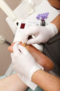 Foot care during a wart treatment