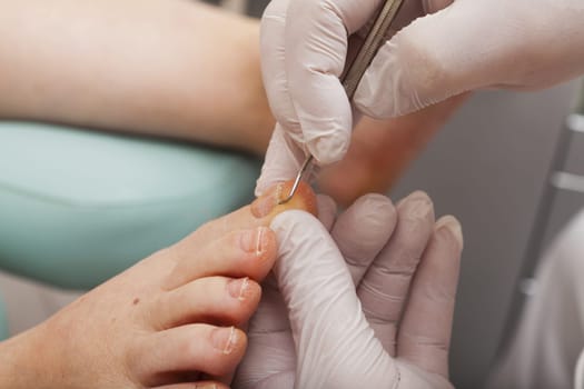 Foot care worker works a footnail with hook