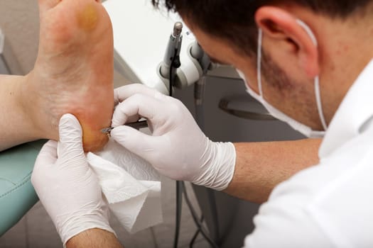 Foot care worker removes cornea on the sole of the foot