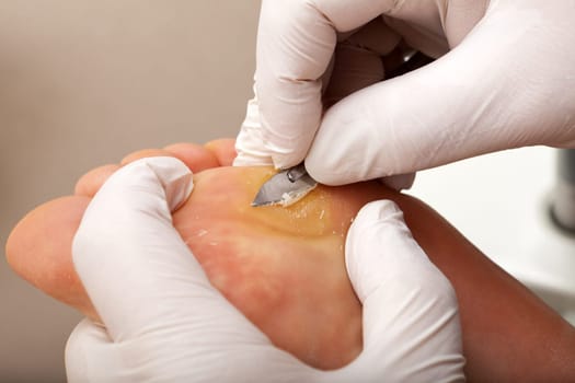 Close-up skin with scalpel remove
