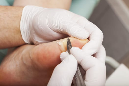 Foot care worker works with a scalpel