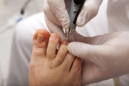 Nail treatment with a foot care worker