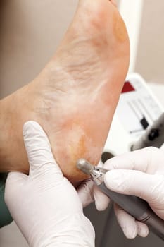 Remove dry skin on the foot
