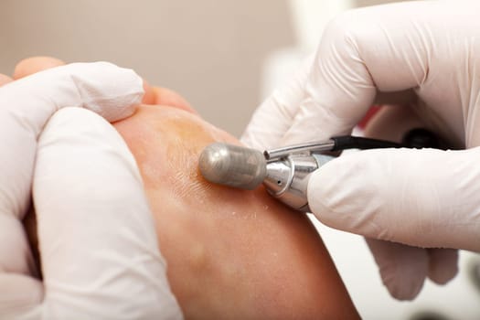 Remove skin from wart with abrasive attachment