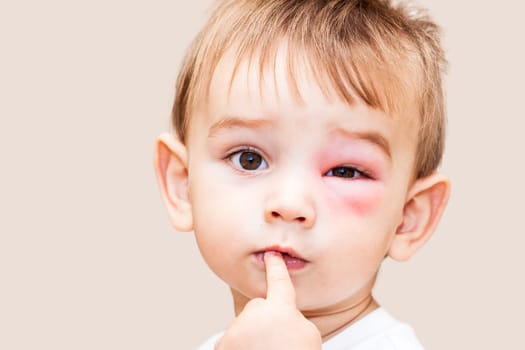 Little Boy - Dangerous Stings From Wasps Near The Eye - Isolated Image