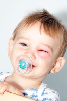 Little Boy - Dangerous Stings From Wasps Near The Eye