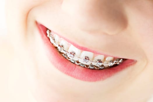 Closeup on braces and white teeth of smiling girl