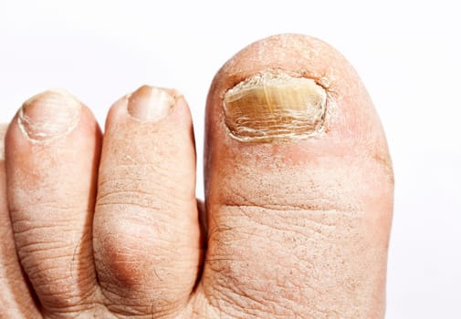 Fungus infection on nails of man's foot