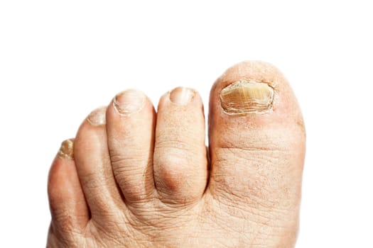 Fungus infection on nails of man's foot