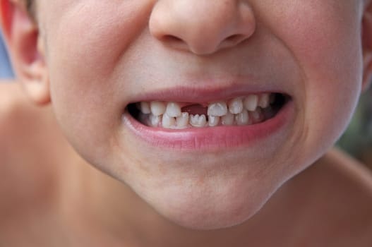 Tooth gap