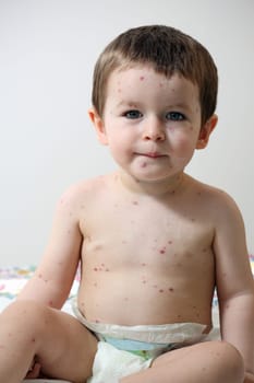 Details of a baby aged 20 months old, he has chickenpox.