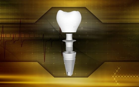Digital illustration Dental implant in colour background