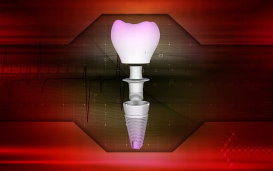 Digital illustration Dental implant in colour background