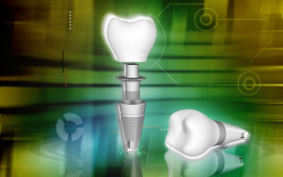Digital illustration Dental implant in colour background