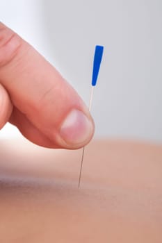 Macro Detail Of A Hand Stimulating An Acupuncture Needle On The Back Of A Patient