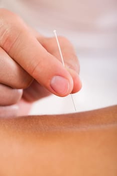 Acupuncture needle inserted by experienced professional only.