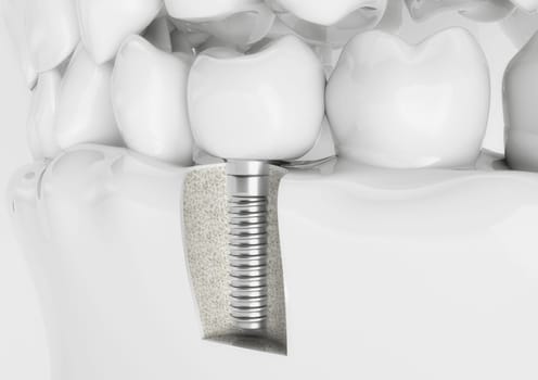Dental implant with crown in a denture model