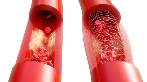 artery with atherosclerosis and next to it after treatment with stent